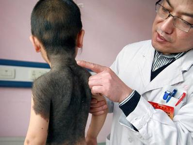 什么原因会长毛痣