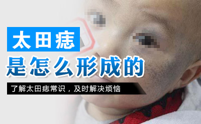 太田痣形成的原因是什么