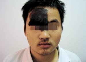 黑毛痣祛除后有哪些需要注意的